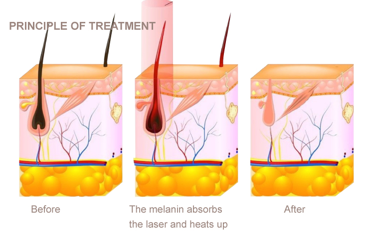 NUBWAY | What is 808nm diode laser?