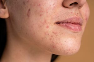 NUBWAY | What does CO2 fractional laser do?