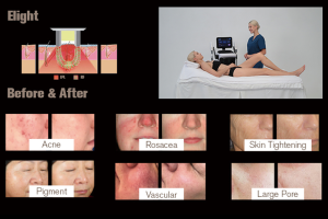 NUBWAY | Do IPL devices really work?