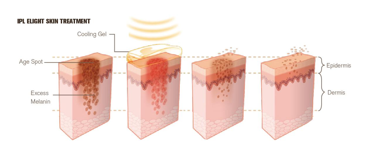 NUBWAY | Glow Up with IPL: Can It Truly Revitalize Your Skin?
