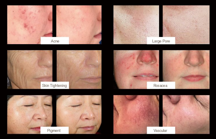 NUBWAY | Glow Up with IPL: Can It Truly Revitalize Your Skin?