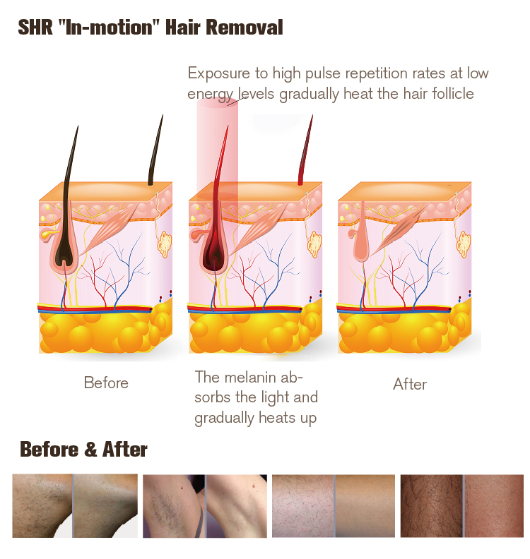 NUBWAY | The IPL vs. Laser Debate: Measuring Relative Effectiveness in Dermatological Applications