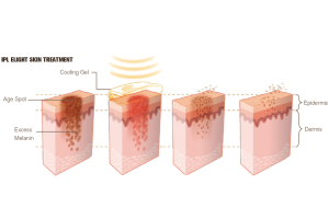 NUBWAY | what is the IPL machine?