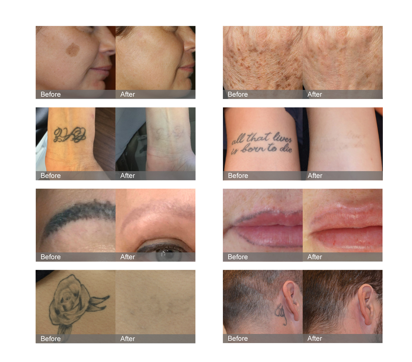 NUBWAY | Flawless Complexion Ahead: YAG Laser's Pigmentation Solution