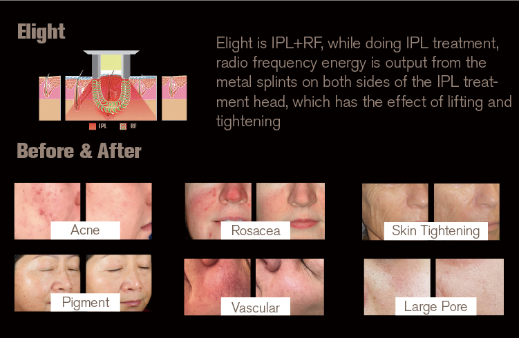 NUBWAY | The IPL vs. Laser Debate: Measuring Relative Effectiveness in Dermatological Applications