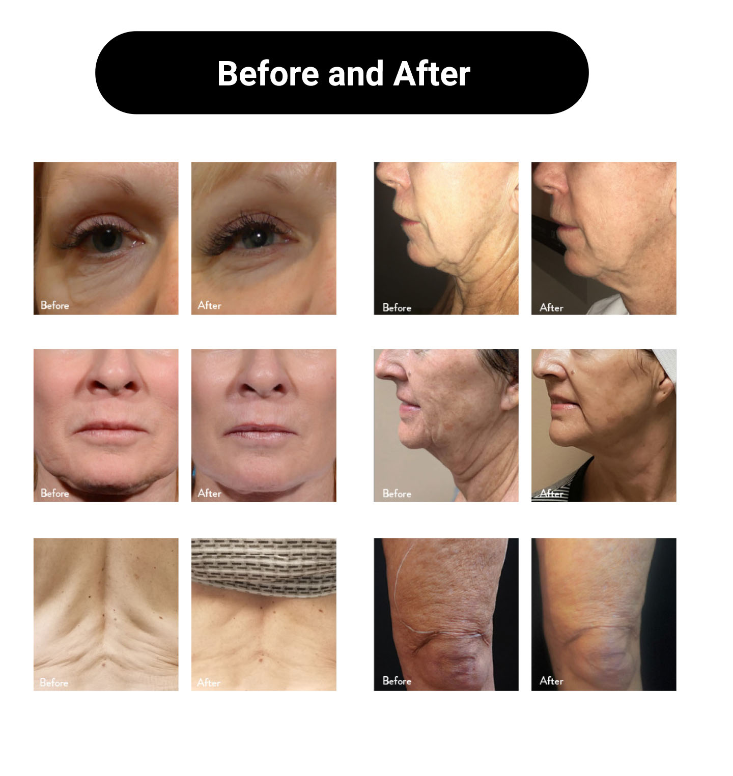 NUBWAY | inner ball roller Therapy Machine