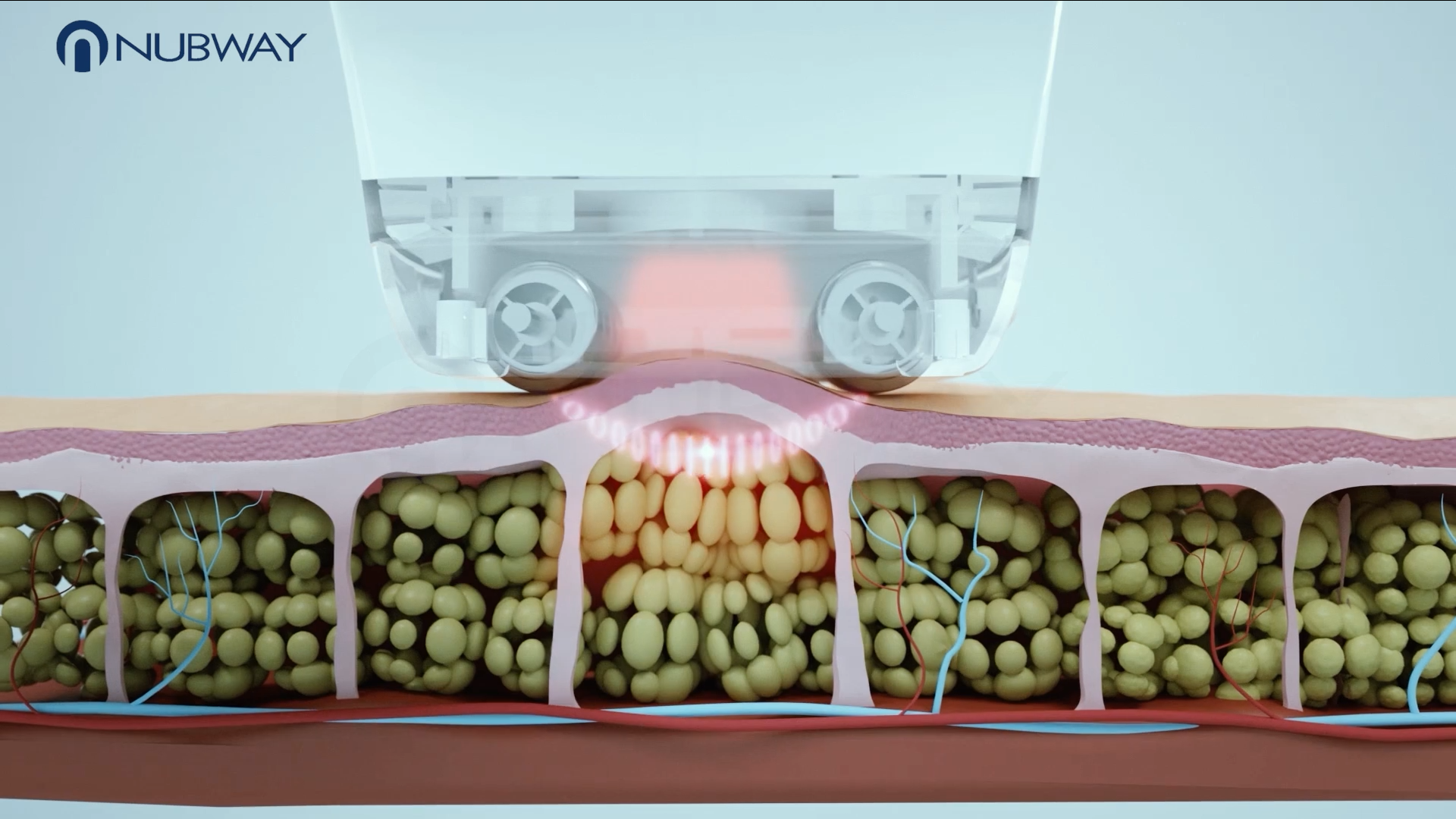 NUBWAY | Non-Surgical Fat Reduction: CoolSculpting or VelaShape–Which Works Better?