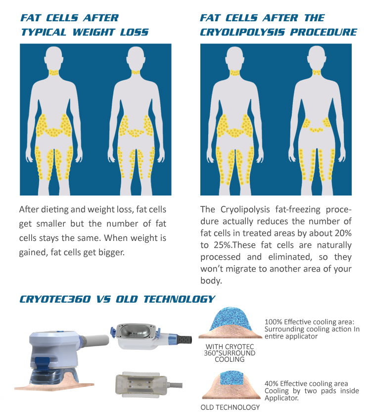 How Long Cryolipolysis Results Last: A Complete Guide-