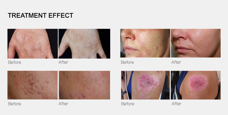 Empowering Change: The Longevity of VelaShape Results-