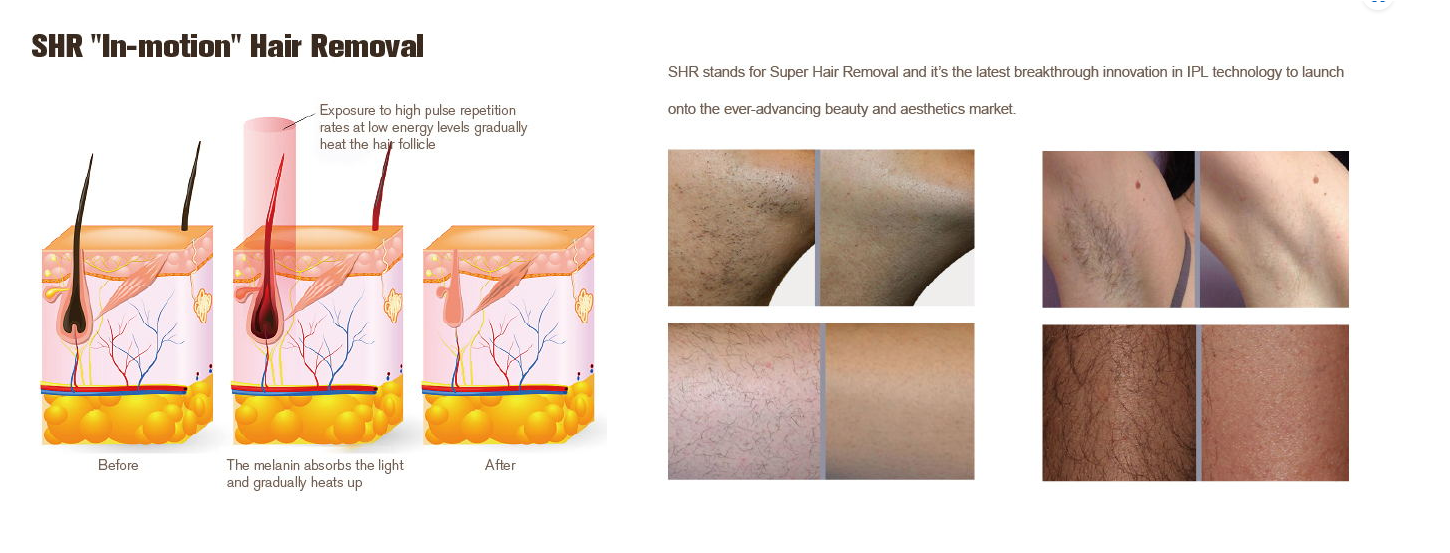 NUBWAY | Can IPL Hair Removal Effects Last Forever? The truth Unveiled