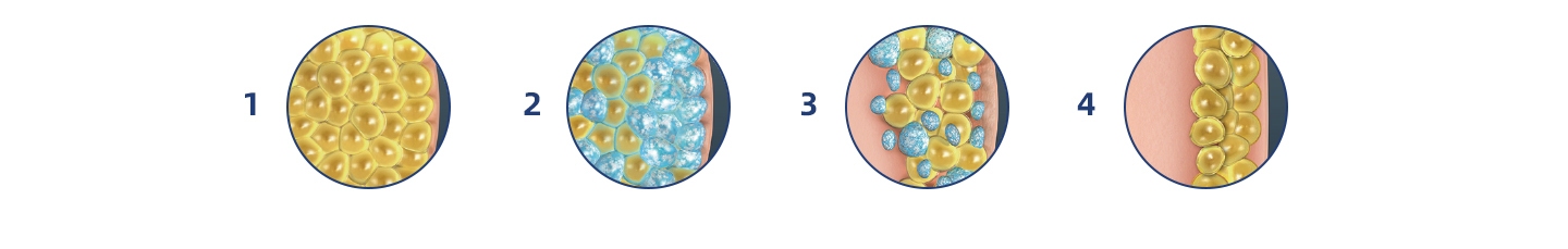 Power of Cryolipolysis Slimming Machines-