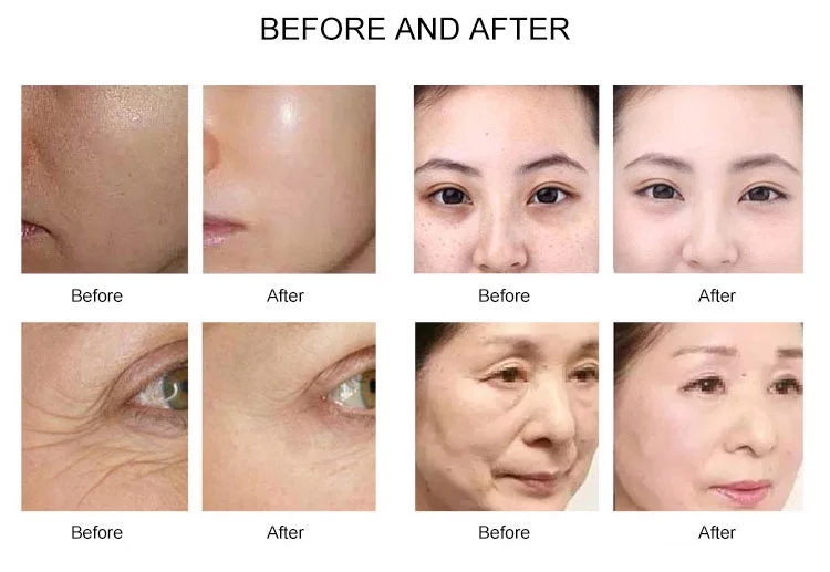 What are the benefits of microneedling?-