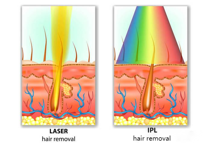 NUBWAY | Can IPL Hair Removal Effects Last Forever? The truth Unveiled