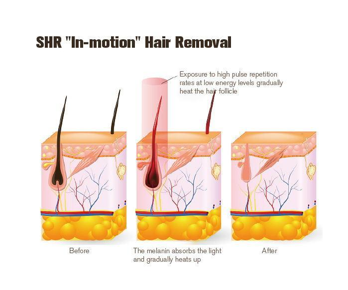 NUBWAY | Can IPL Hair Removal Effects Last Forever? The truth Unveiled