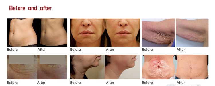 NUBWAY | Solving the Mystery: How Long a HIFU Face Lasts