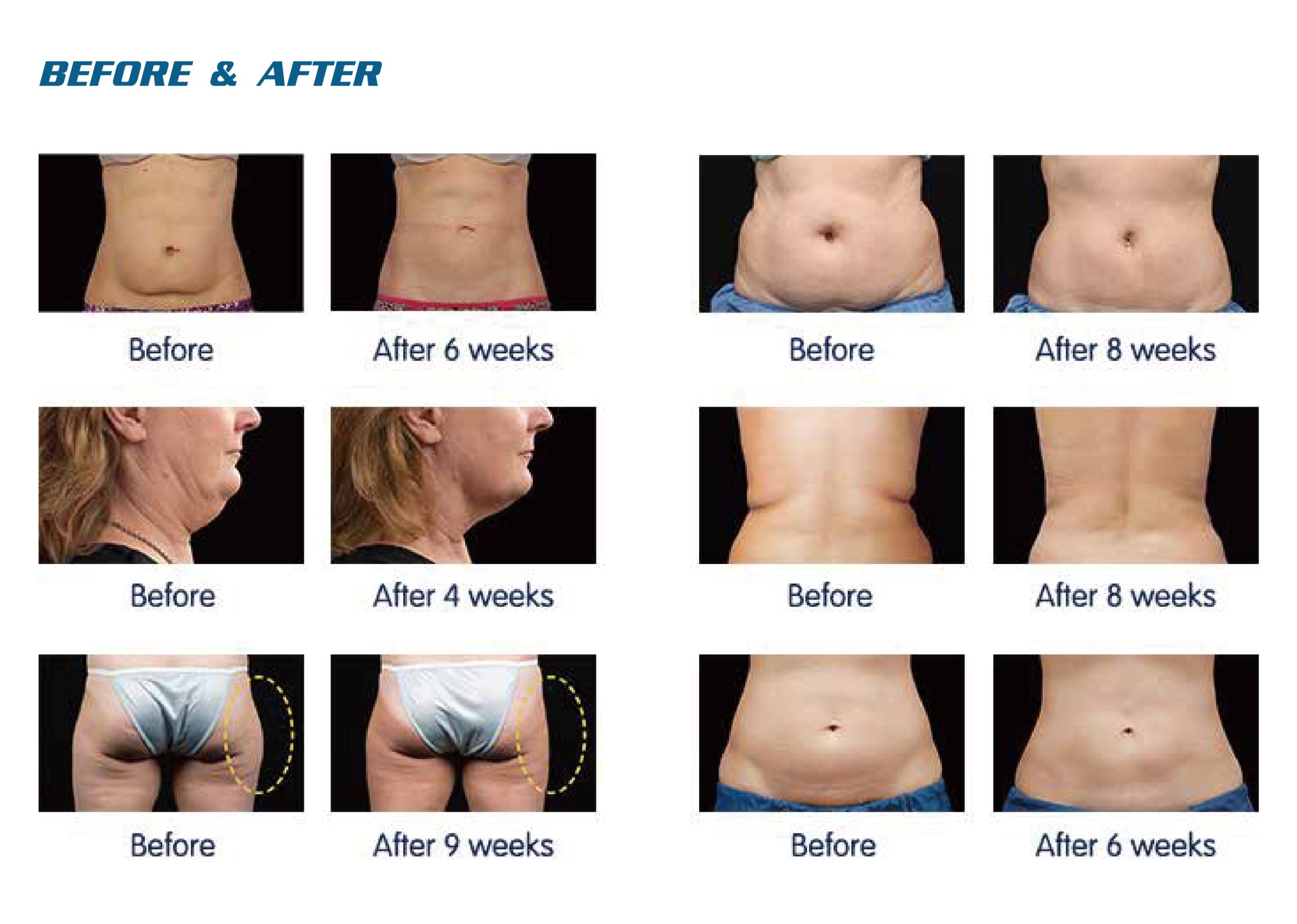 NUBWAY | Inside Look: Managing Extreme Temperatures After Cryolipolysis Treatment