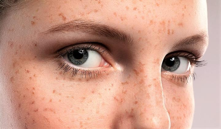 NUBWAY | What is picosecond laser good for?