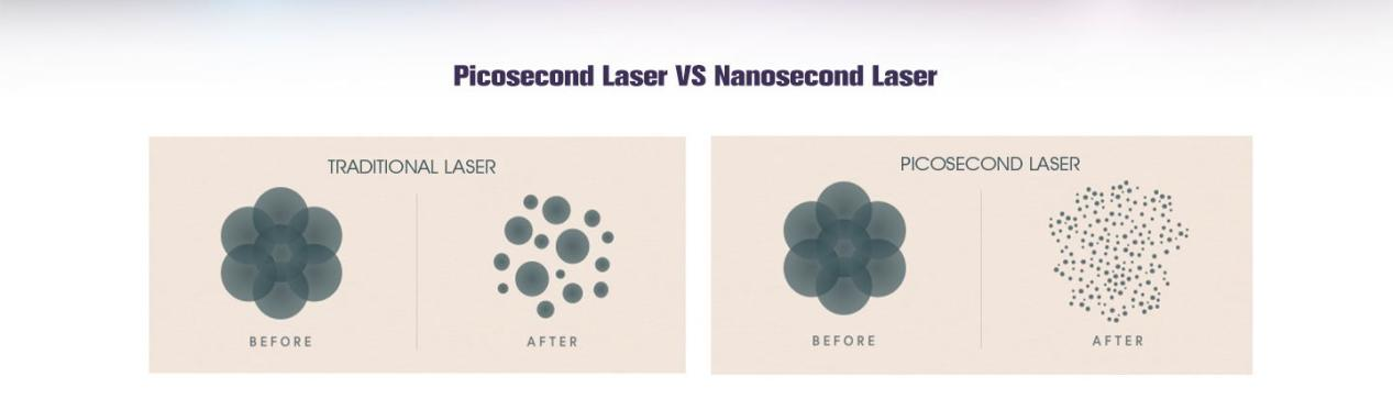 NUBWAY | What is picosecond laser good for?