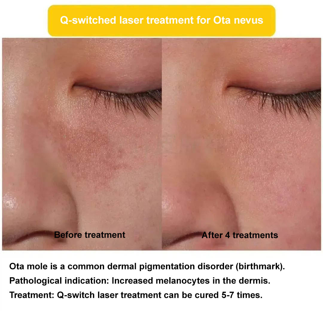 Diagnosis and treatment of Ota nevus-4
