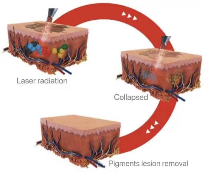 NUBWAY | At-Home Picosecond Devices: Safe for Melasma? Dermatologists Weigh In 2024