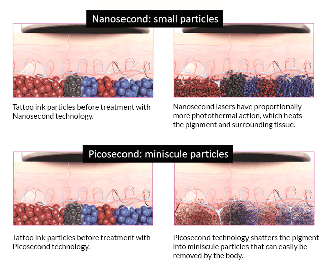 NUBWAY | Which laser is best for pigmentation?