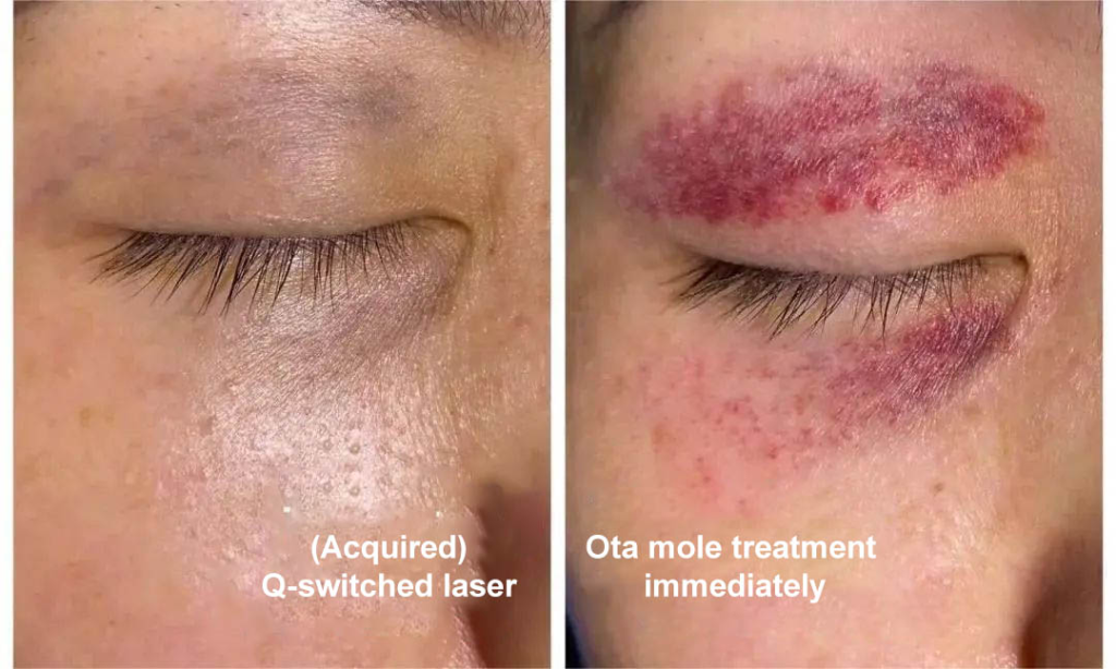 what-is-a-picosecond-laser-used-for-nubway