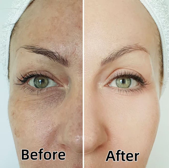 NUBWAY | At-Home Picosecond Devices: Safe for Melasma? Dermatologists Weigh In 2024