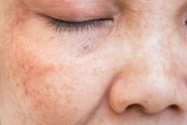 NUBWAY | At-Home Picosecond Devices: Safe for Melasma? Dermatologists Weigh In 2024
