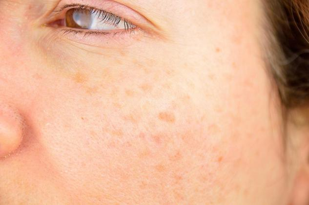 NUBWAY | At-Home Picosecond Devices: Safe for Melasma? Dermatologists Weigh In 2024