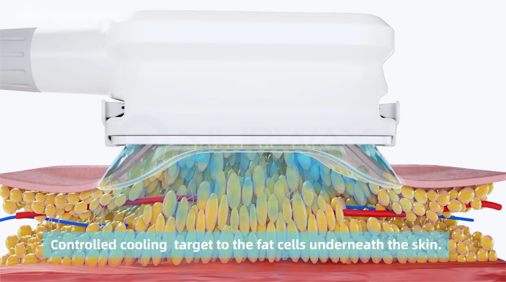 NUBWAY | Which is better, CoolSculpting or VelaShape?