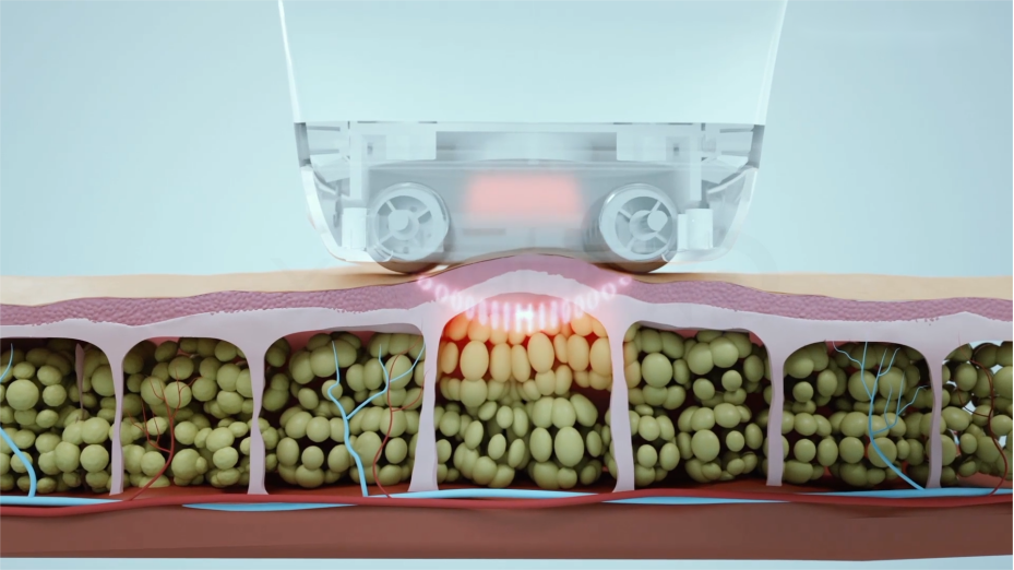 NUBWAY | Which is better, CoolSculpting or VelaShape?