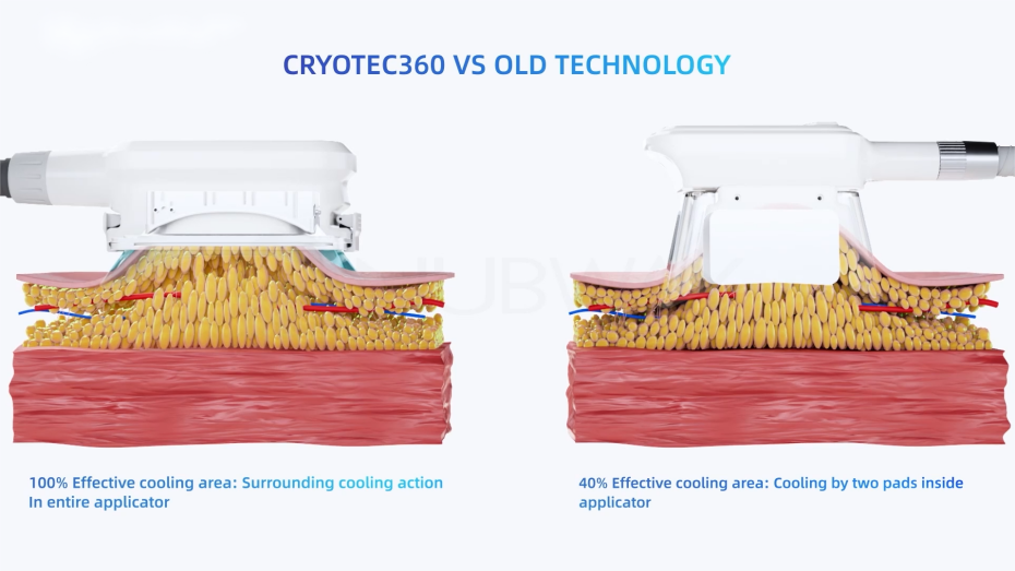 Which is better, CoolSculpting or VelaShape?-8