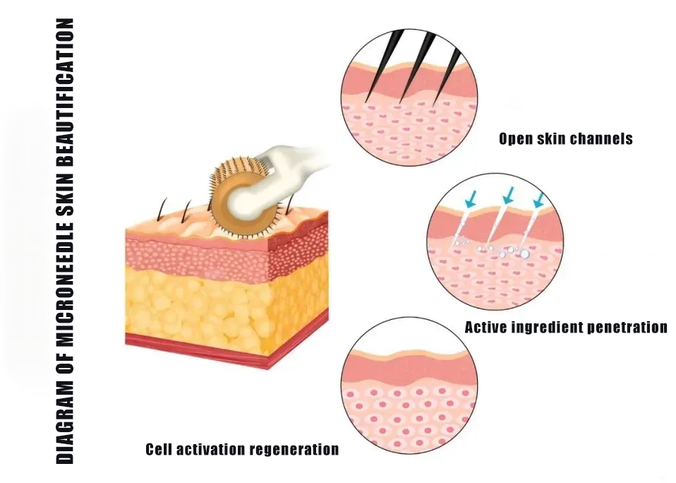 NUBWAY | RF Microneedling Unveiled: Your Key to Flawless Skin