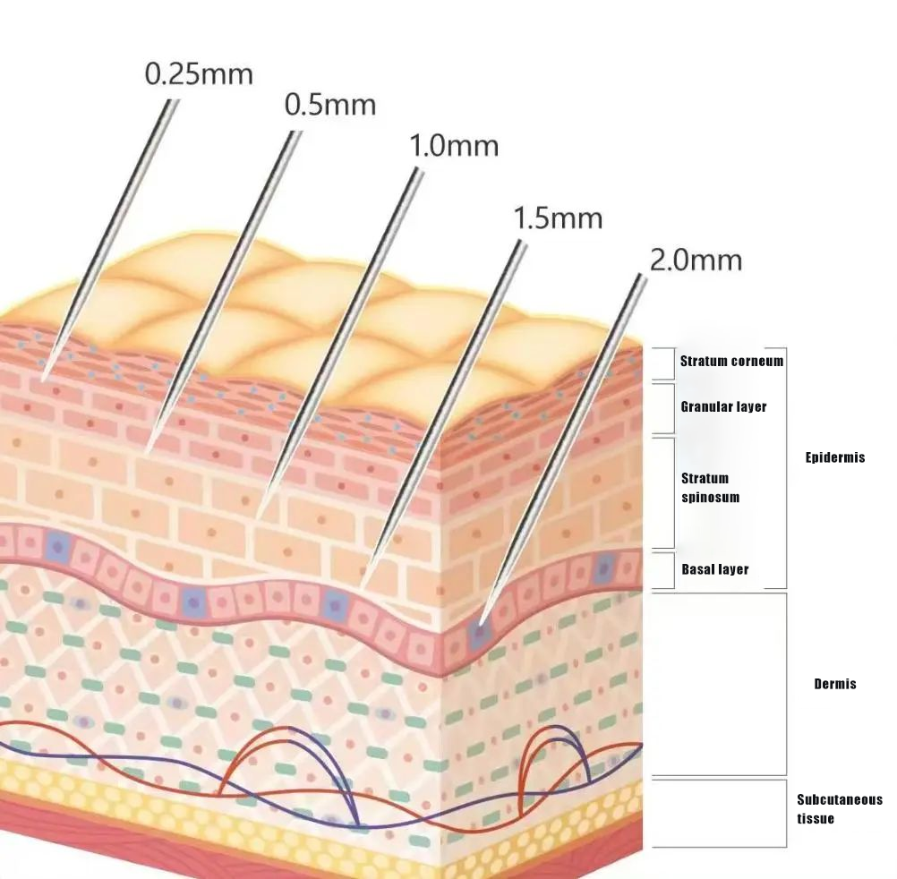NUBWAY | RF Microneedling Unveiled: Your Key to Flawless Skin