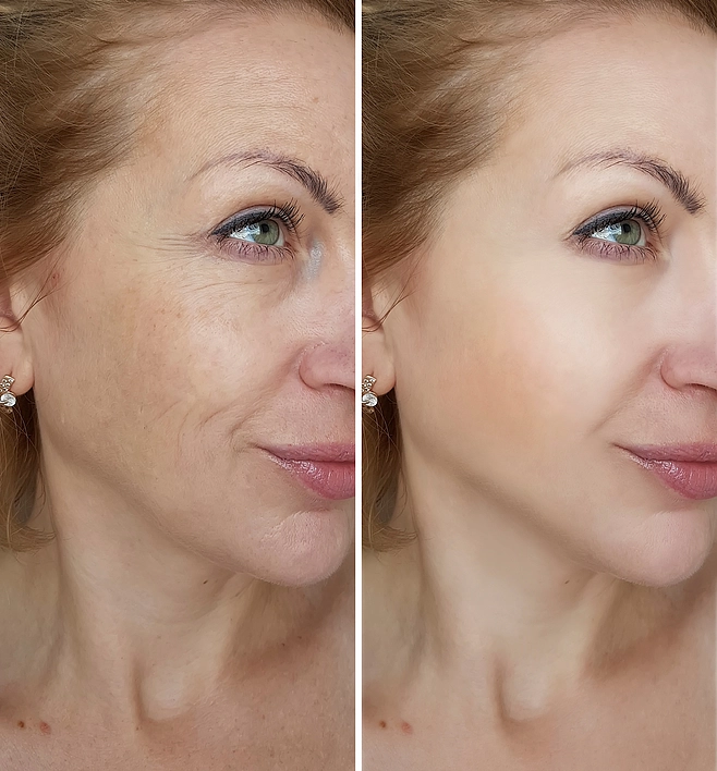 NUBWAY | Application of radio frequency(RF) in skin beauty