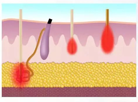 Is microneedling better at home or professional？-