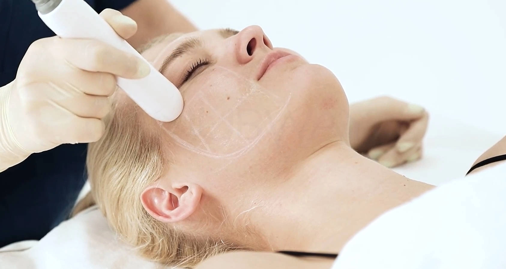 NUBWAY | Understanding HIFU: How Long Does HIFU Treatment Last?