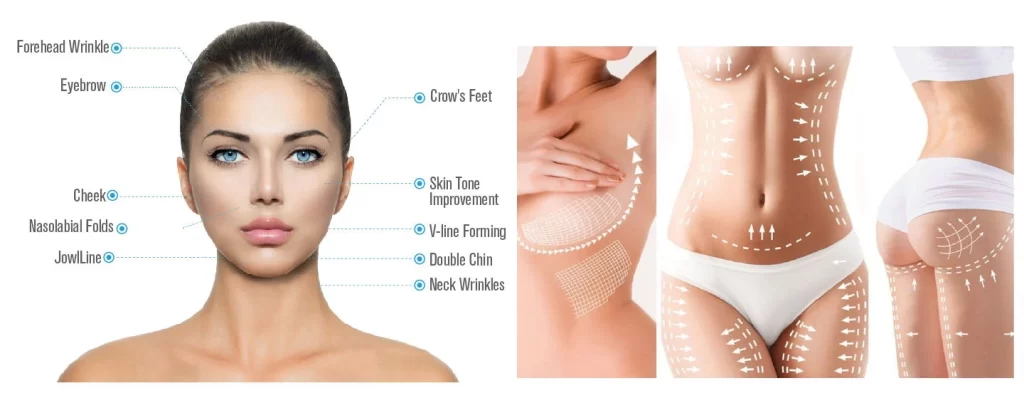 NUBWAY | HIFU Before and After: Understanding the Skin Transformation Process
