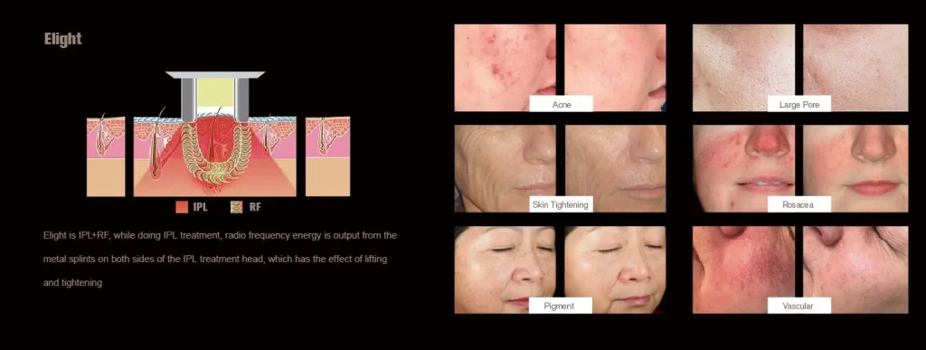 NUBWAY | How Long Does IPL Skin Rejuvenation Last? A Closer Look