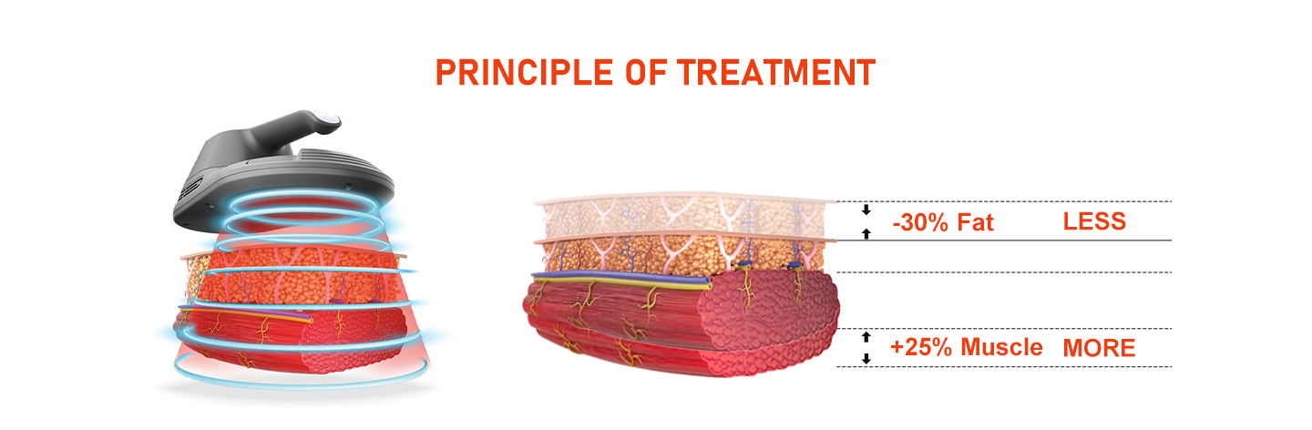 NUBWAY | Electromagnetic Body Sculpting(EMS): Evaluating the Scientific Evidence