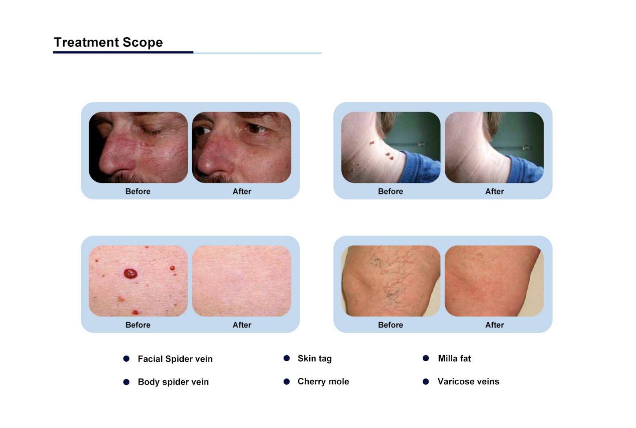 NUBWAY | Spider Vein Removal: Evaluating Treatment Efficacy and Clinical Outcomes