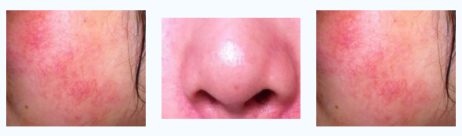 NUBWAY | Spider Vein Removal: Evaluating Treatment Efficacy and Clinical Outcomes