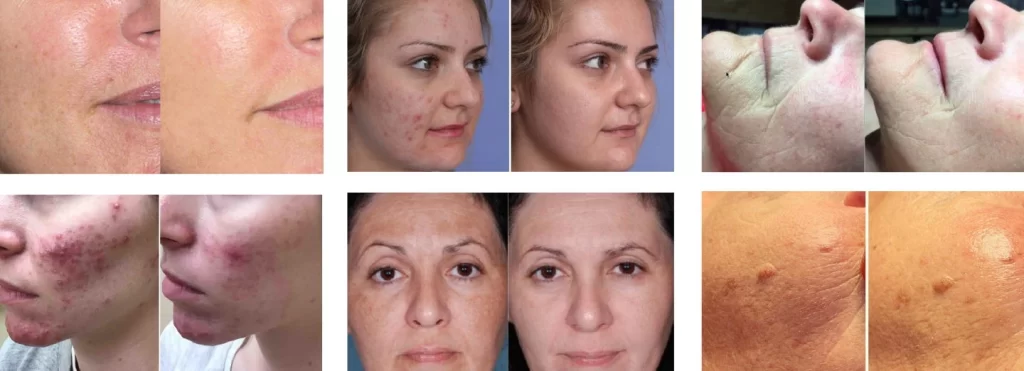 NUBWAY | How Does LED Light Therapy Make It A Worthy Choice?