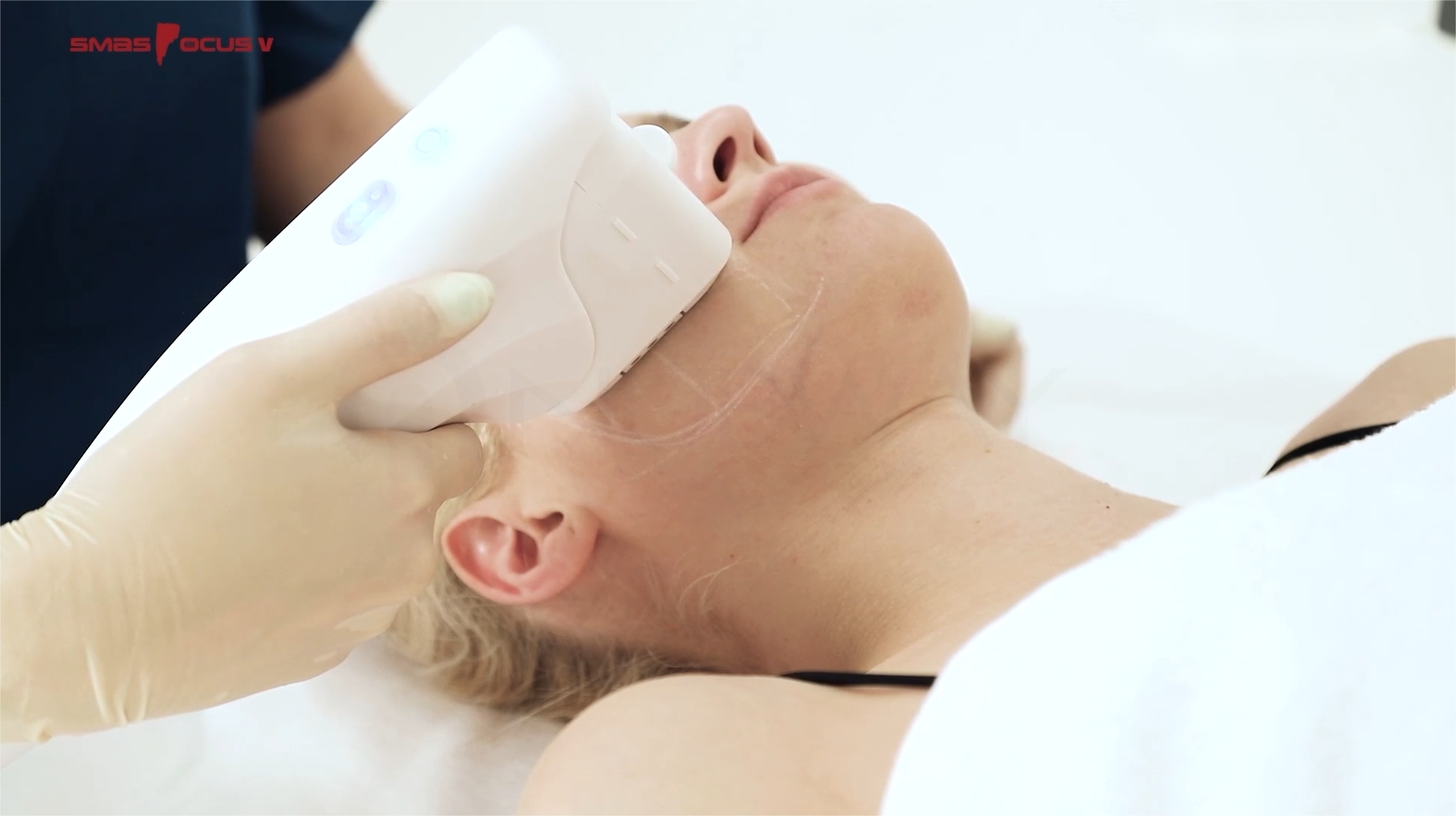 NUBWAY | HIFU Treatment: Measuring the Duration of Facial Tightening Results
