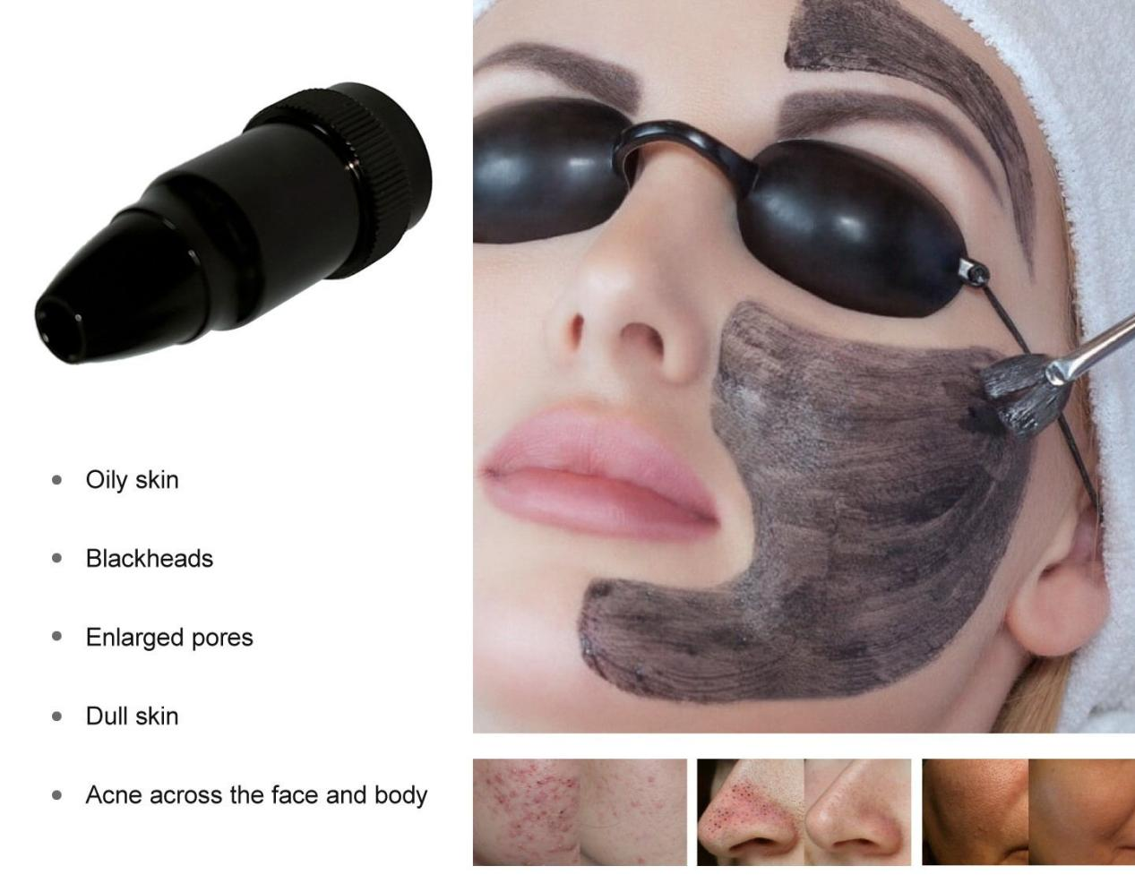 NUBWAY | Pico Laser vs. Nd:YAG Laser: What’s the Difference?