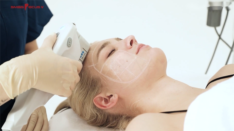 NUBWAY | HIFU Treatment: Measuring the Duration of Facial Tightening Results