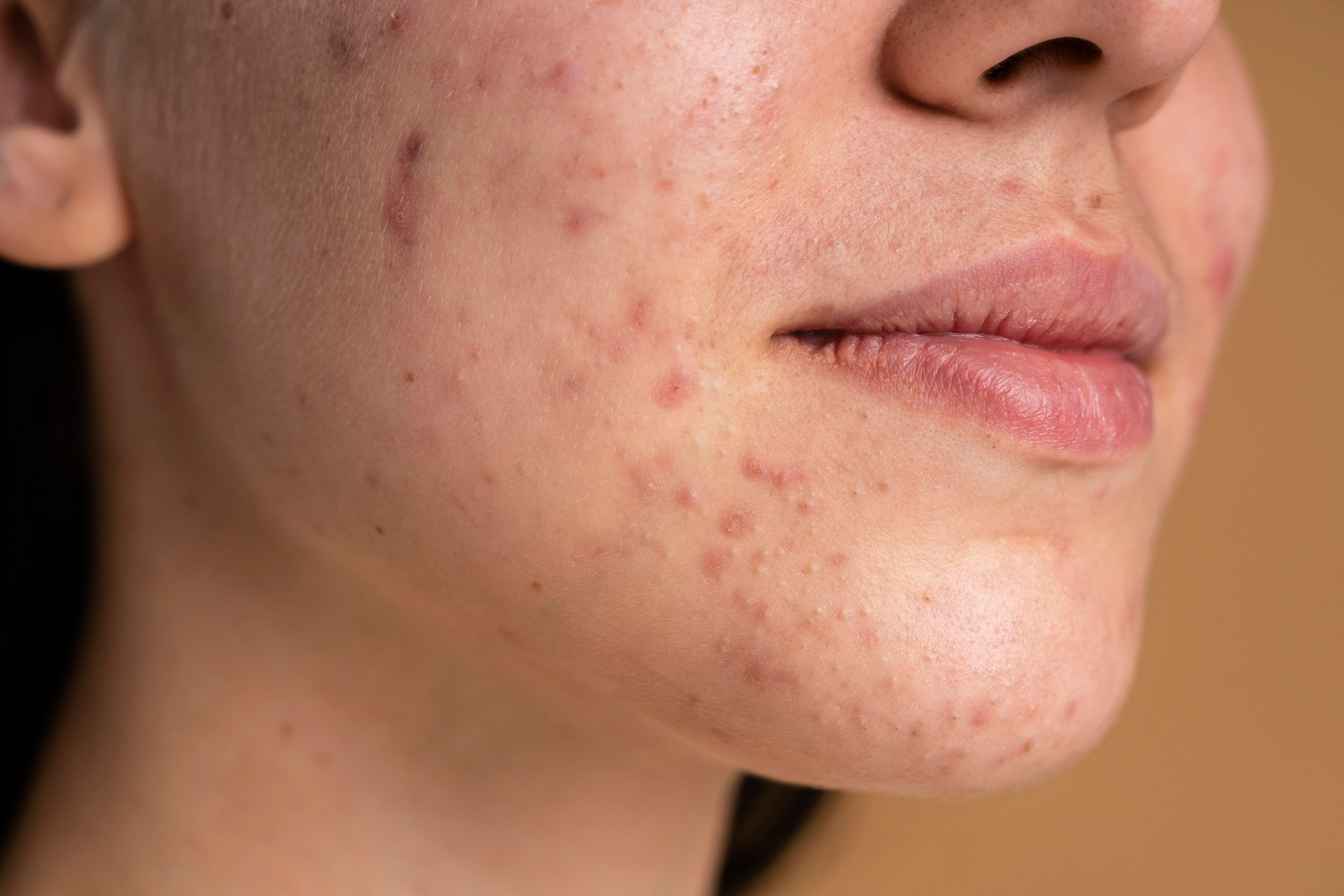 NUBWAY | Who Can Benefit Most from Picosecond Laser Therapy?