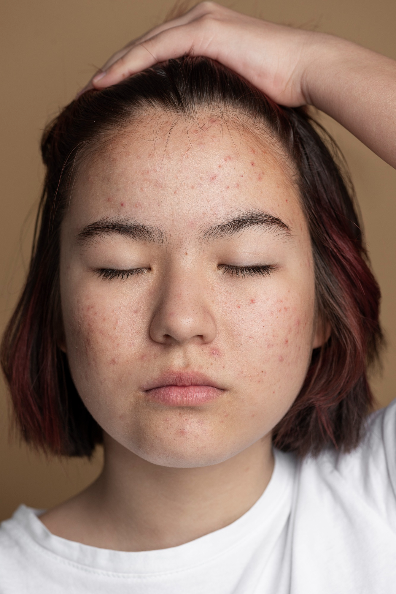 NUBWAY | Who Can Benefit Most from Picosecond Laser Therapy?