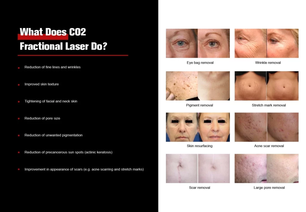 NUBWAY | Preparing for Your CO2 Laser Treatment: Essential Steps to Follow