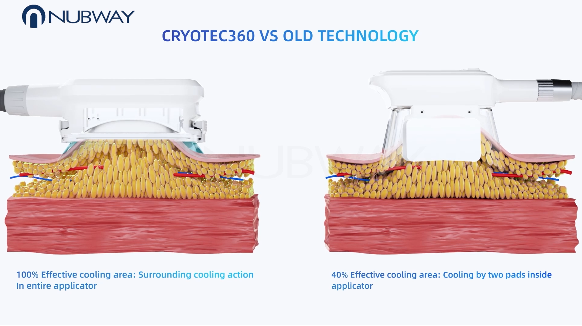 NUBWAY | Home Use Coolsculpting Machines: Are They Available for Purchase?